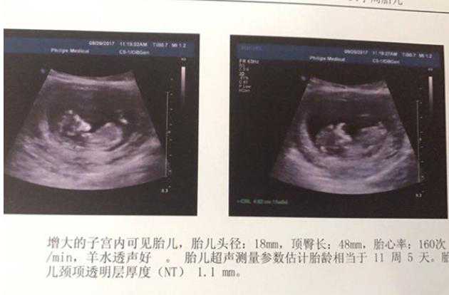 杭州有偿供卵试管网 2022杭州卵巢早衰做试管成功率因素分析 ‘孕早期看孕囊能
